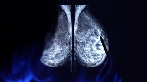 Doctor with a pan checking mammogram x-ray. Mammography diagnostic to prevent breast cancer. 4k close up video.