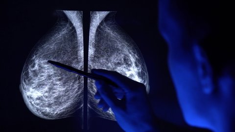 Doctor with a pan checking mammogram x-ray. Mammography diagnostic to prevent breast cancer. 4k close up video.