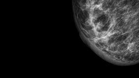Close up of Mammogram X Ray Analysis. Mammography diagnostic to prevent breast cancer. 4k video