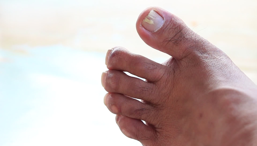 Fungus toes nail dirty human feet concept for care health nails