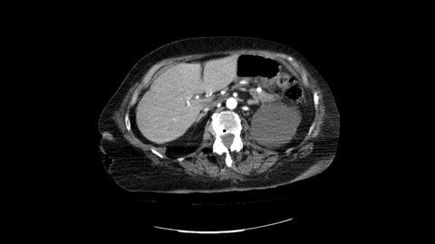 Magnetic Resonance Imaging, Delayed chest wall hematoma caused by progressive displacement of rib fractures, Broken rib scan