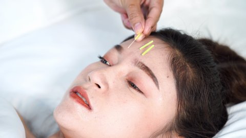 young woman undergoing acupuncture treatment on head