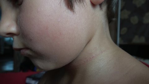 4K Small child with scratch on his neck
