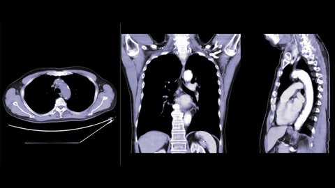 CT Chest with Contrast or CTA pulmonary artery axial NC ,Coronal and sagittal view for diagnosis pulmonary embolism and lung disease.