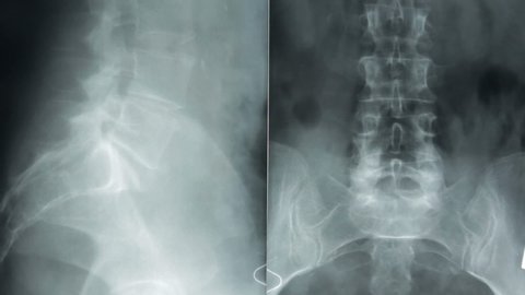 Xray Lumbosacral Spine Normal Perfect Stock Photo 1290672328 | Shutterstock