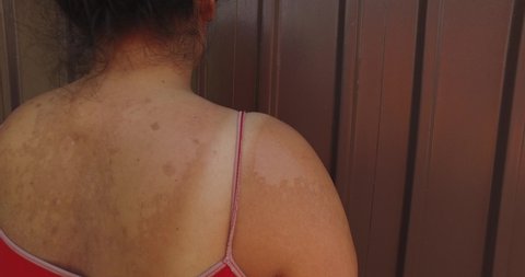 The girl in the shade, touching and scratching skin that is peeling after a sunburn, shot of back with beauty spots, mole.