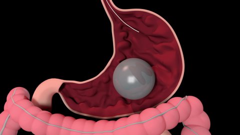 This video shows the Endoscopic insertion of the Gastric Balloon for weight loss