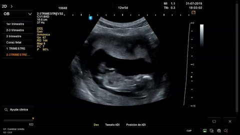 ultrasound baby 12 weeks of life