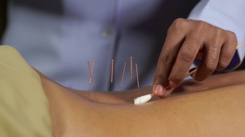 close up woman undergoing acupuncture treatment on back