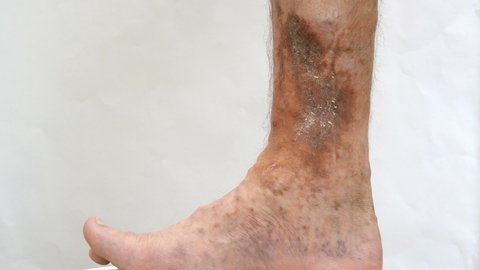 Illness of the human skin. A person s hands touch and scratch scars, ulcers and age spots, possibly after varicose veins on his leg.