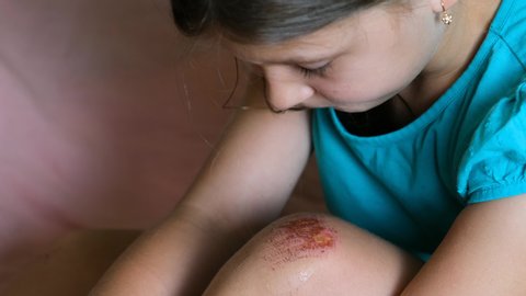 Wounded knee of the child, abrasions on the girl lap. close-up