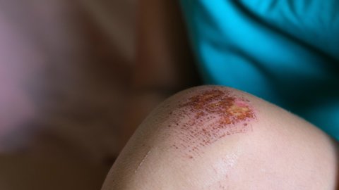 Wounded knee of the child, abrasions on the girl lap. close-up