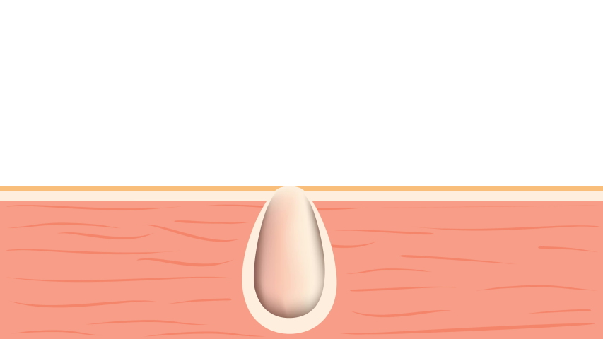 Formation of skin acne or pimple. The sebum in the clogged pore promotes the growth of a certain bacteria. This leads to the redness and inflammation associated with pimples | Shutterstock HD Video #1034910896