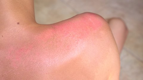 Severe sunburn symptoms: redness, pain, skin peeling, skin burning and blistering