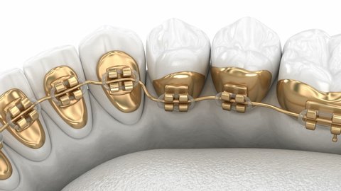 Lingual braces system. 3D animation concept of golden braces