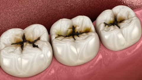 Molar teeth damaged by caries. Medically accurate tooth 3D animation