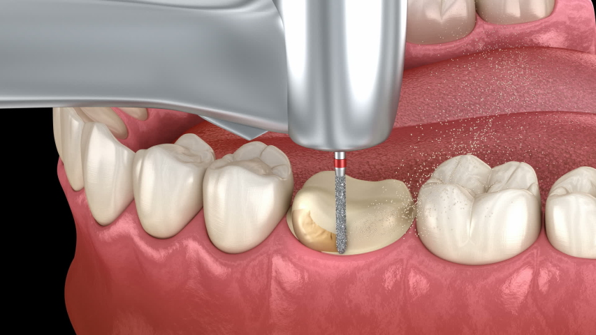 Dental turbine Stock Video Footage - 4K and HD Video Clips | Shutterstock