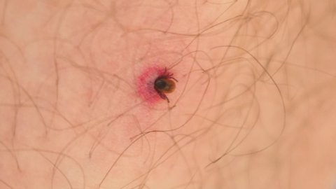 Macro close-up of a tick embedded in a person's skin after it has burrowed and is feeding on human blood