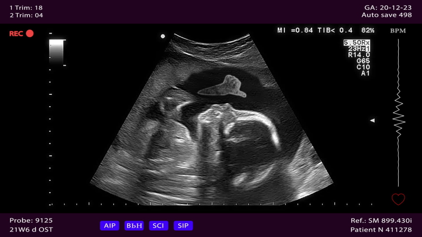 Baby in the womb, ultrasonography screen, second trimester of pregnancy. An unborn child raised his thumbs up. Medical examination screen, seamlessly loop conceptual footage Royalty-Free Stock Footage #1035711614