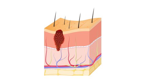Skin cancer: Squamous cell carcinoma, basal-cell cancer (begins in the basal cells) and Melanoma (arises in the pigment cells, melanocytes). layers of human skin and healthy epidermis