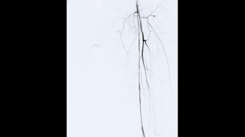  Angiogram of left femoral artery showing vessel isolated on white background  for diagnosis atherosclerosis.