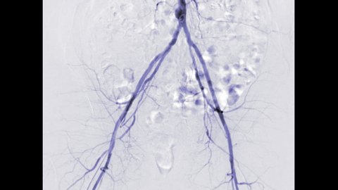 Angiogram Femoral Artery Showing Vessel Isolated Stock Footage Video ...