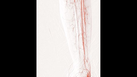 Peripheral Angiogram  of left femoral artery showing vessel isolated on white background  for diagnosis atherosclerosis.