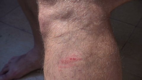 Slow motion male finger smears medicine on the scratch on the leg.