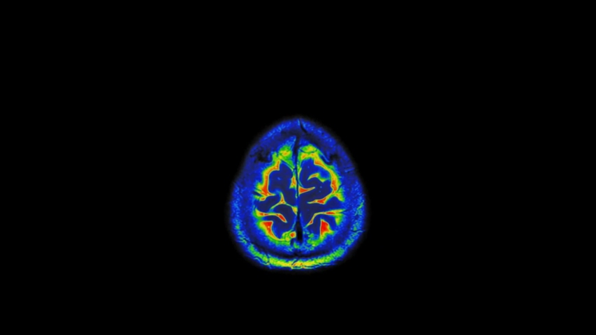 MRI Scan of Normal Healthy Brain  (Magnetic Resonance Imaging) Ultra HD 4k Time Lapse- Loop Record Royalty-Free Stock Footage #1036010687