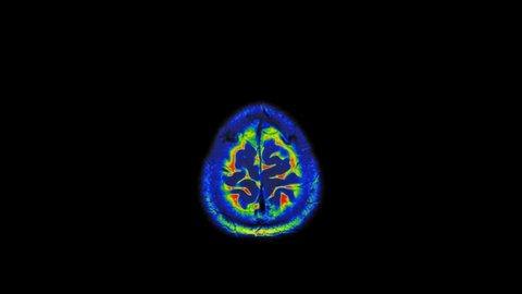 MRI Scan of Normal Healthy Brain  (Magnetic Resonance Imaging) Ultra HD 4k Time Lapse- Loop Record