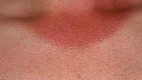 Closeup macro view of male sunburned red skin of neck. Real time 4k video footage.