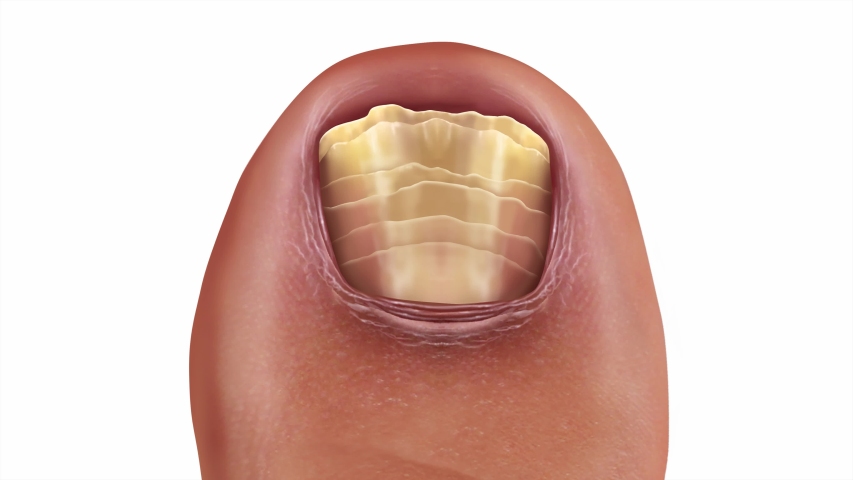 Fungal nail infection recovery diagram toe nail with damaged unhealthy and healthy human anatomy as a 4K video. | Shutterstock HD Video #1036322888