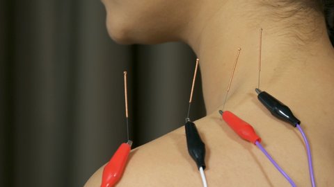 young woman undergoing acupuncture treatment with electrical stimulator on shoulder