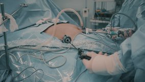 Operation using laparoscopic equipment in hospital-4K 