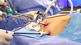 Operation using laparoscopic equipment- 1080p Full HD