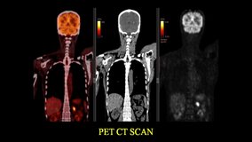 PET CT Scan of Human Body (Positron Emission Tomography) 4k Collage Video/ Time Lapse - Loop Record
