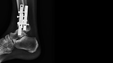 x-ray footage fracture at tibia bone with internal fixation 
