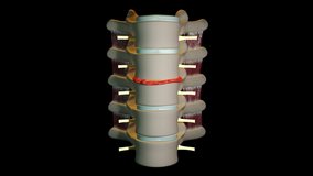 This video a Spine injury treatment