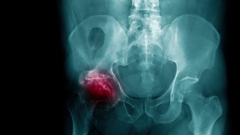hip degenerative change x-ray footage with red hight light, hip avascular necrosis 
