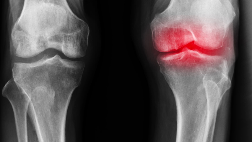 Gout knee Stock Video Footage - 4K and HD Video Clips | Shutterstock