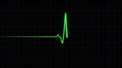 Cardiac arrest on the medical monitor, heart stops beating. The human heart beats twice then deadline on a grid screen. Heartbeat monitor EKG green line. Seamlessly loop footage.