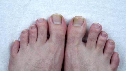 Large uncut toenails with fungus. The man has yellow toenails. Long did not cut your nails