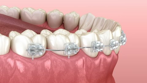 Elastics Metal Braces Correction Overbite Frontal Stock Illustration ...