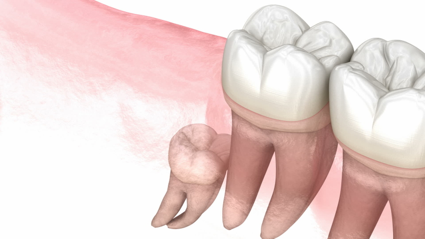 Vertical, Horizontal and Distal impaction of Wisdom tooth. Medically accurate tooth 3D animation  Royalty-Free Stock Footage #1037395679