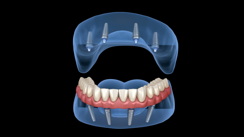 Maxillary and Mandibular prosthesis with gum All on 4 system supported by implants. Medically accurate 3D animation of human teeth and dentures Royalty-Free Stock Footage #1037395682