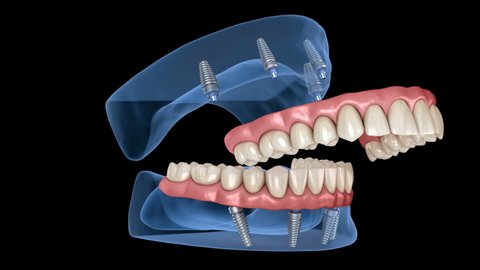 Maxillary and Mandibular prosthesis with gum All on 4 system supported by implants. Medically accurate 3D animation of human teeth and dentures