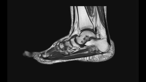 MRI FOOT Sagittal T2  for diagnostic tendon injury.