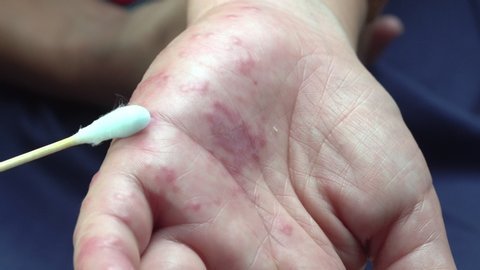 Nurse cleaning blisters shingles on patient hand