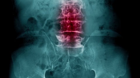 severe lumbar spondylosis or degenerative change of spine with scaning animation footage