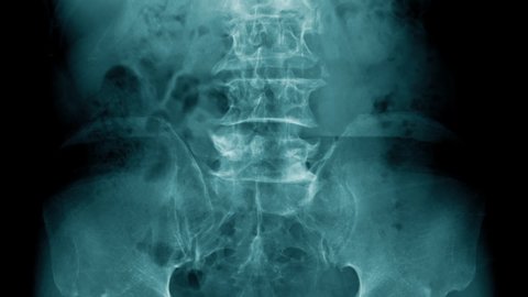 lumbar spondylosis or degenerative change of spine with scaning animation footage